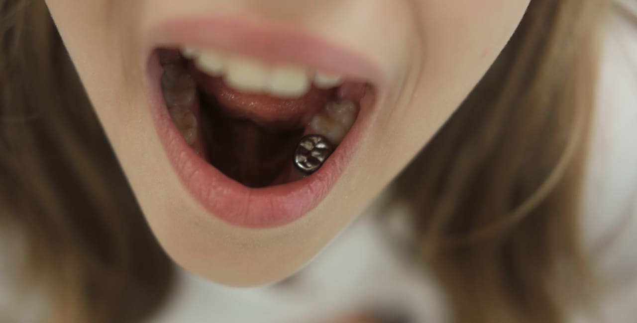 Dental Crowns for Kids