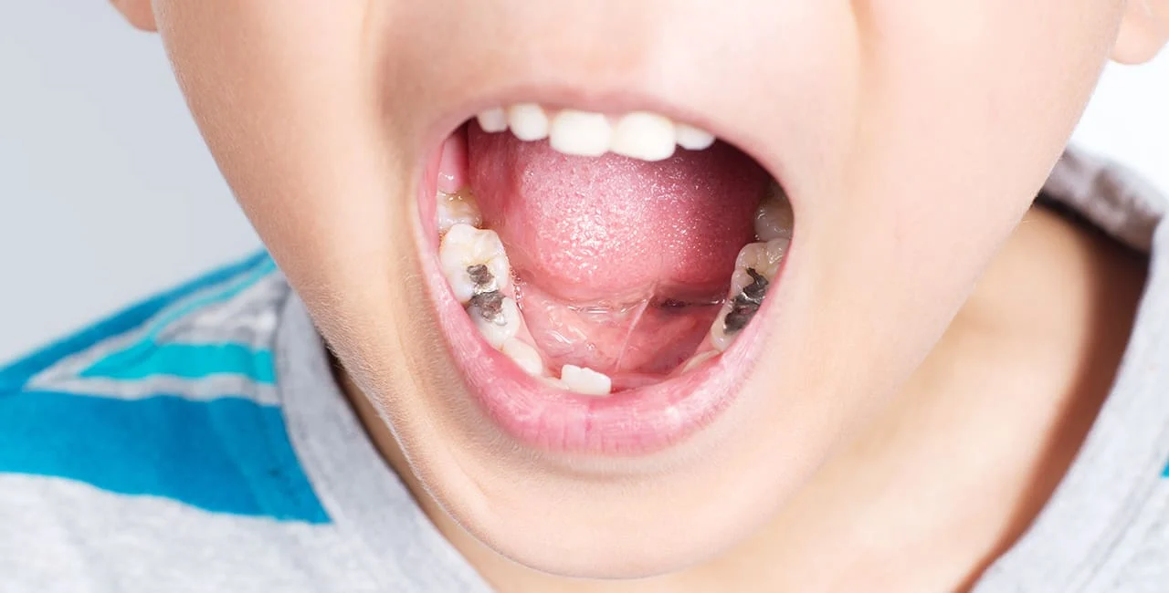 Dental Fillings for Kids